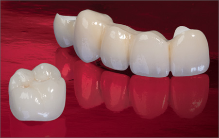 Porcelain Dental Crowns